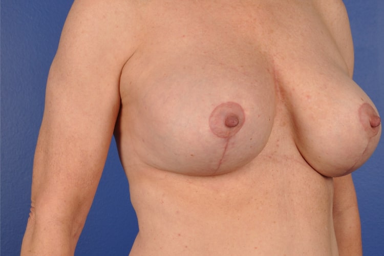 Breast Implant Revision Before & After Image