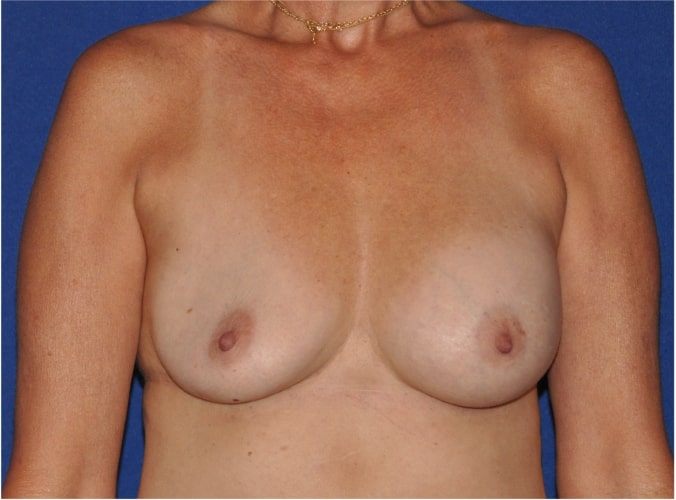 Breast Implant Revision Before & After Image