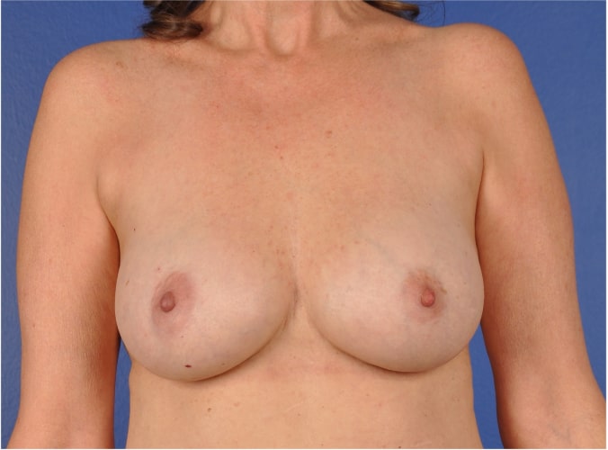 Breast Implant Revision Before & After Image