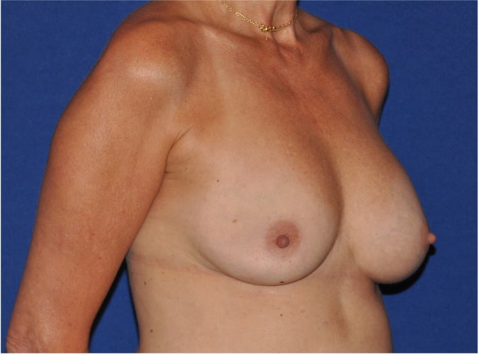 Breast Implant Revision Before & After Image